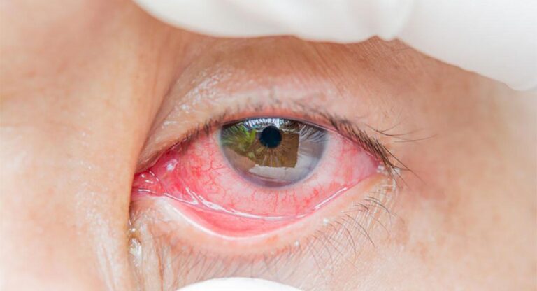 Problemas Palpebrais