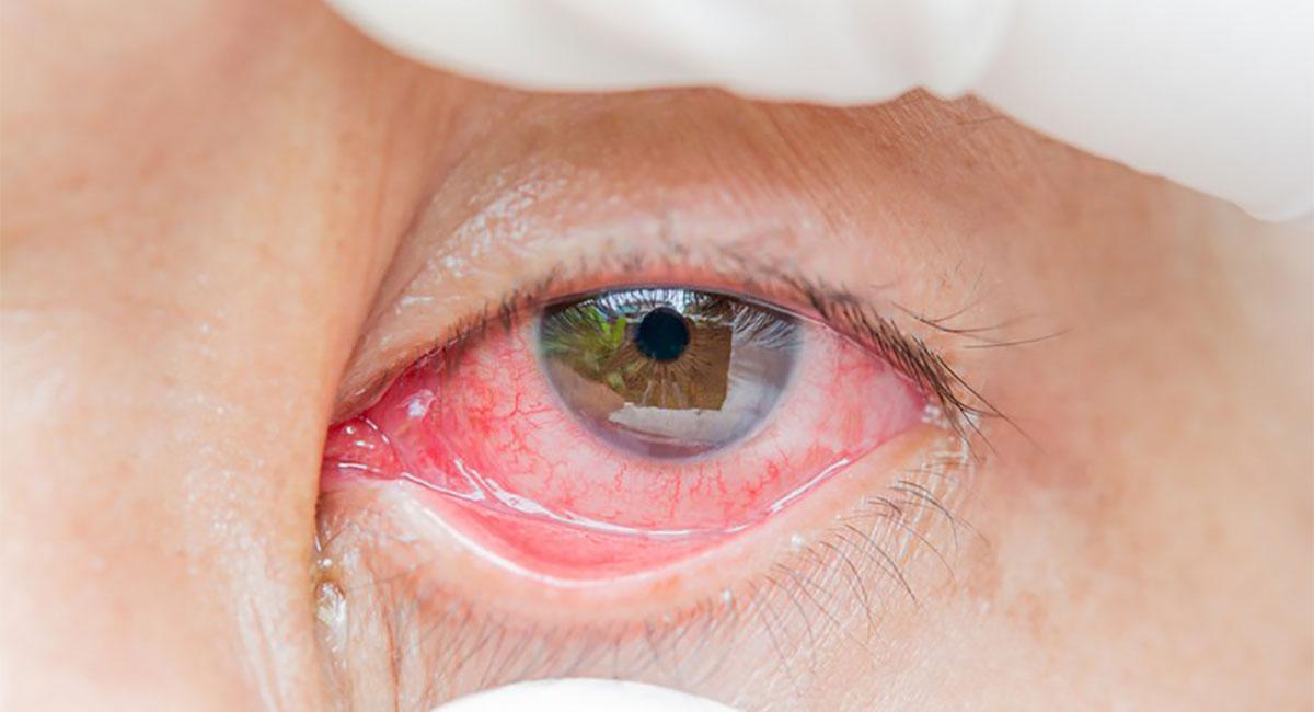 Problemas Palpebrais